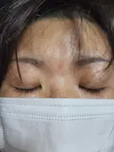 二重埋没 湘南美容クリニック 千葉センシティ院 AFTER サムネイル用