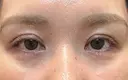 自然癒着法 銀座リシェスクリニック AFTER サムネイル用