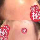ルメッカ MIO CLINIC 梅田院 DAY 9 サムネイル用