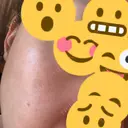 リジュラン ミニマムスキンクリニック池袋 AFTER サムネイル用