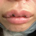 口角挙上 / その他（口元） アネシス美容クリニック DAY 4 サムネイル用