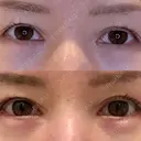 目尻切開 / タレ目形成・グラマラスライン（埋没） LOUIS CLINIC 二子玉川院【ルイクリニック】 DAY 11 サムネイル用