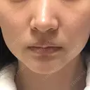 RF（高周波）たるみ治療 あいちビューティークリニック DAY 11 サムネイル用
