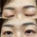 二重切開 / 上まぶたたるみ取り / 上まぶたの脂肪取り VIDA BEAUTY CLINIC DAY 7 サムネイル用