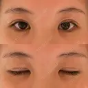 二重切開 / 眼瞼下垂（切開） / 上まぶたたるみ取り ユア美容クリニック 福岡院 DAY 12 サムネイル用