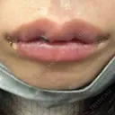 口角挙上 / その他（口元） アネシス美容クリニック DAY 5 サムネイル用