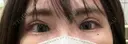 二重切開 / 眼瞼下垂（切開） オーキッド美容クリニック東京御徒町 DAY 74 サムネイル用