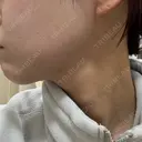 ボトックス（エラ・小顔） フィラークリニック 大阪心斎橋院 AFTER サムネイル用