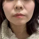 ボトックス（エラ・小顔） フィラークリニック 大阪心斎橋院 DAY 11 サムネイル用