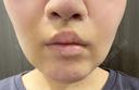 その他（鼻） / 人中短縮 / 鼻柱下降・鼻唇角形成（猫手術） Otus Clinic 【オータスクリニック】 DAY 7 サムネイル用