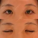 二重切開 / 眼瞼下垂（切開） / 上まぶたたるみ取り ユア美容クリニック 福岡院 DAY 13 サムネイル用