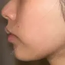 ボトックス（額） ルラ美容クリニック銀座院 DAY 3 サムネイル用