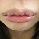 口角挙上 / その他（口元） アネシス美容クリニック DAY 6 サムネイル用