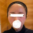 脂肪注入（額） EMMA CLINIC（エマクリニック） DAY 13 サムネイル用