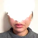 糸リフト / 脂肪吸引（顔） EMMA CLINIC（エマクリニック） DAY 14 サムネイル用