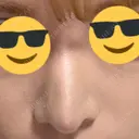 鼻尖形成（切開） / 軟骨移植 / 骨切幅寄せ / プロテーゼ除去 9BeautyClinic DAY 87 サムネイル用