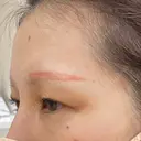 アートメイク除去・修正 渋谷美容外科クリニック 新宿院 DAY 103 サムネイル用