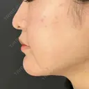 糸リフト / 脂肪吸引（顔） / ボトックス（エラ・小顔） HAAB×DREAM BEAUTY CLINIC 東京本院 DAY 114 サムネイル用