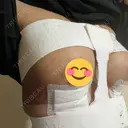 豊胸（シリコンバッグ） / その他（胸） お茶の水美容形成クリニック DAY 3 サムネイル用