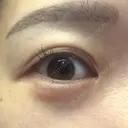 ヒアルロン酸注入（涙袋） 銀座美容外科クリニック 銀座院 DAY 9 サムネイル用