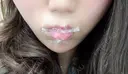 ヒアルロン酸注入（あご） / ボトックス（エラ・小顔） / ヒアルロン酸注入（唇） TCB東京中央美容外科 郡山院 DAY 46 サムネイル用