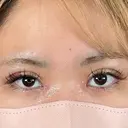 二重埋没 / 目頭切開 アリエル美容クリニック 大宮院 DAY 7 サムネイル用