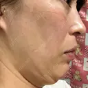 脂肪吸引注射（顔） 湘南美容クリニック 甲府院 DAY 12 サムネイル用