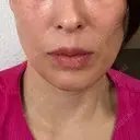 脂肪吸引注射（顔） 湘南美容クリニック 甲府院 DAY 14 サムネイル用