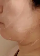脂肪吸引（顔） / 眉下切開 / ヒアルロン酸注入（首） 春山記念病院 DAY 1 サムネイル用