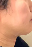 脂肪吸引（顔） / 眉下切開 / ヒアルロン酸注入（首） 春山記念病院 DAY 3 サムネイル用