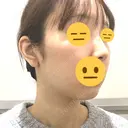 脂肪吸引注射（顔） ルラ美容クリニック 名古屋栄院 / ルラスキンクリニック 名古屋栄院 DAY 10 サムネイル用