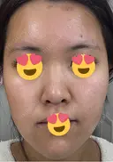 医療脱毛（顔） 日本美容・医療クリニック 六本木院 DAY 0 サムネイル用