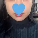 RF（高周波）たるみ治療 LUNA BEAUTY CLINIC 池袋駅前院 DAY 36 サムネイル用
