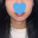RF（高周波）たるみ治療 LUNA BEAUTY CLINIC 池袋駅前院 AFTER サムネイル用