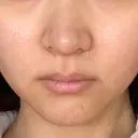 RF（高周波）たるみ治療 あいちビューティークリニック DAY 16 サムネイル用