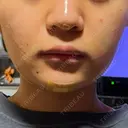 二重埋没 / 糸リフト / 脂肪吸引注射（顔） / ヒアルロン酸注入（涙袋） / 肌ヒアルロン酸注入（たるみ・シワ改善） / ヒアルロン酸注入（あご） / ボトックス（エラ・小顔） / ヒアルロン酸注入（唇） / ボトックス（口角） / シワ取りボトックス / その他（鼻） / その他（口元） TCB東京中央美容外科 熊本院 DAY 2 サムネイル用