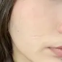 ポテンツァ 上野美容外科・美容皮膚科 AFTER サムネイル用