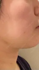 脂肪吸引（顔） / 眉下切開 / ヒアルロン酸注入（首） 春山記念病院 DAY 4 サムネイル用