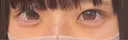 ヒアルロン酸注入（涙袋） Olino美容外科・美容皮膚科 DAY 0 サムネイル用
