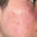 ルメッカ ルラ美容クリニック 大宮院 / ルラスキンクリニック 大宮院 DAY 0 サムネイル用