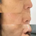ピコレーザートーニング（美白・肝斑） / フラクショナルレーザー（毛穴・ニキビ跡） Mavie Beauty Clinic （マヴィービューティークリニック） DAY 21 サムネイル用