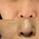 ピコレーザートーニング（美白・肝斑） / フラクショナルレーザー（毛穴・ニキビ跡） Mavie Beauty Clinic （マヴィービューティークリニック） DAY 28 サムネイル用