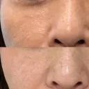 ピコレーザートーニング（美白・肝斑） / フラクショナルレーザー（毛穴・ニキビ跡） Mavie Beauty Clinic （マヴィービューティークリニック） DAY 49 サムネイル用