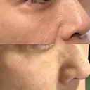 ピコレーザートーニング（美白・肝斑） / フラクショナルレーザー（毛穴・ニキビ跡） Mavie Beauty Clinic （マヴィービューティークリニック） DAY 56 サムネイル用