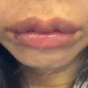 口角挙上 / その他（口元） アネシス美容クリニック DAY 10 サムネイル用