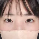 クマ治療 / ヒアルロン酸注入（目の下） / ヒアルロン酸注入（鼻翼基部） / スネコス Tokyo Tensei Clinic 銀座院 AFTER サムネイル用