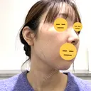 脂肪吸引注射（顔） ルラ美容クリニック 名古屋栄院 / ルラスキンクリニック 名古屋栄院 DAY 12 サムネイル用