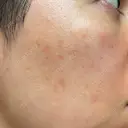 ルメッカ ルラ美容クリニック 大宮院 / ルラスキンクリニック 大宮院 DAY 1 サムネイル用