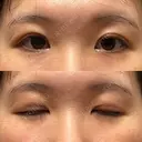 二重切開 / 眼瞼下垂（切開） / 上まぶたたるみ取り ユア美容クリニック 福岡院 DAY 17 サムネイル用