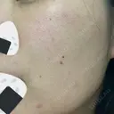 ルメッカ Belle Via Skin Clinic DAY 5 サムネイル用